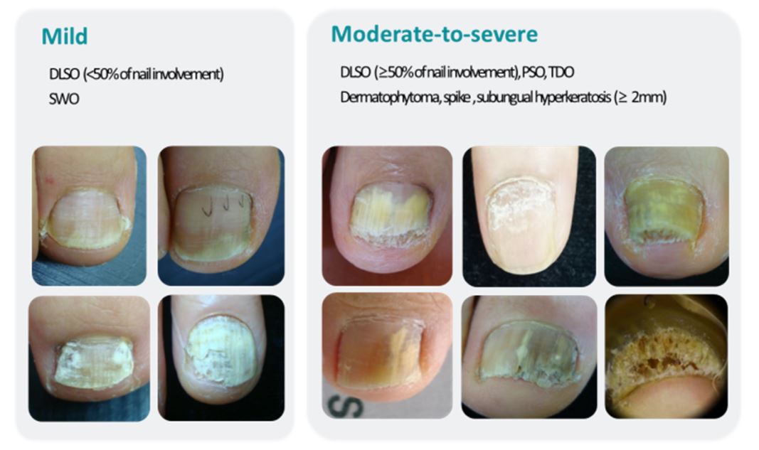 distal and lateral subungual onychomycosis