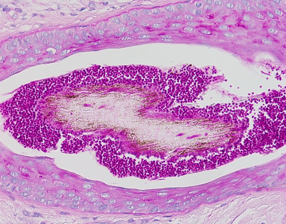 Dermatomycosis barbae, AKA fungal neckbearditis. [Warning: gross