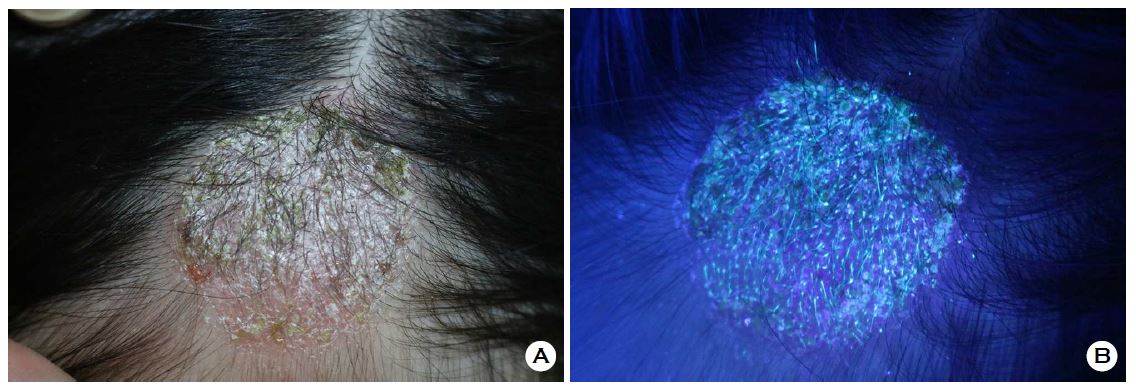 Tinea Capitis Due to Microsporum canis