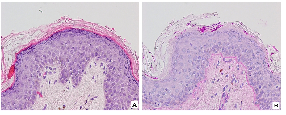 Dermatomycosis barbae, AKA fungal neckbearditis. [Warning: gross