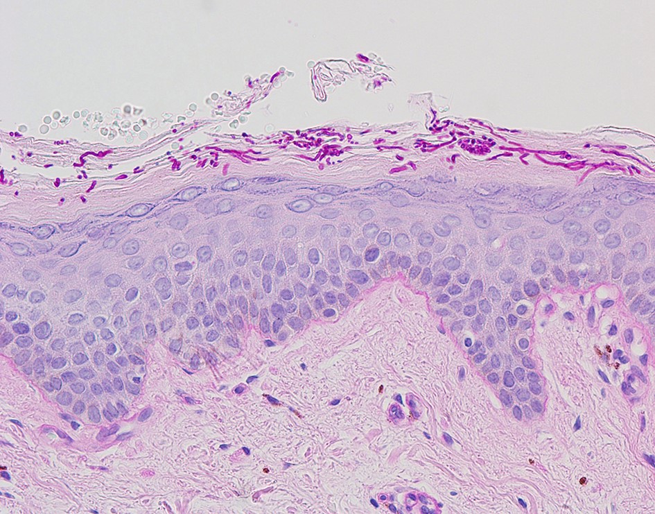 Dermatomycosis barbae, AKA fungal neckbearditis. [Warning: gross