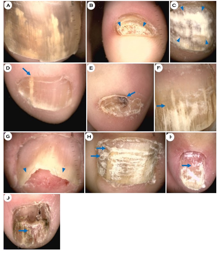 Dark lines on nails | MDedge Family Medicine