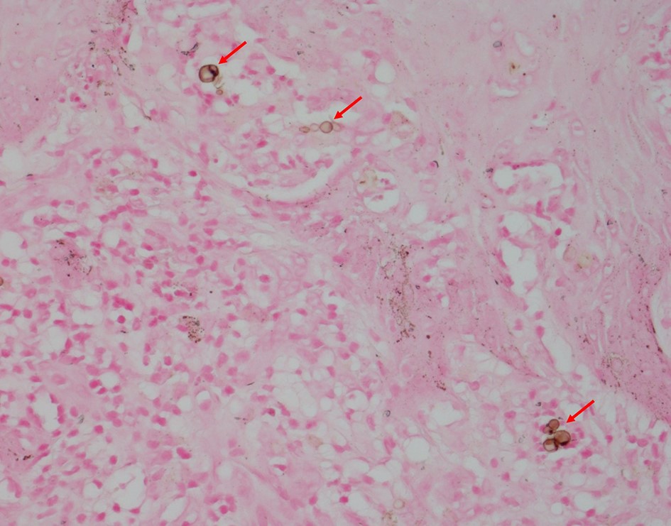 Dermatomycosis barbae, AKA fungal neckbearditis. [Warning: gross