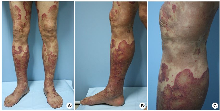 Tinea Capitis Caused by Trichophyton Tonsurans