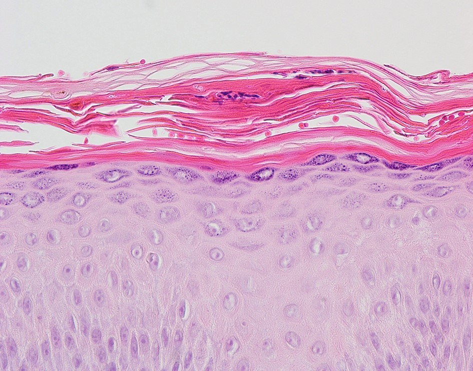 Dermatomycosis barbae, AKA fungal neckbearditis. [Warning: gross